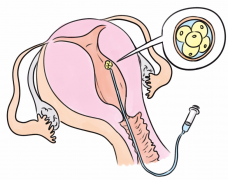 输卵管积水可以做试管婴儿吗